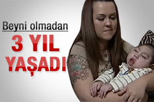 Beyni olmadan 3 yıl yaşadı
