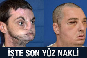 Yeni bir yüz nakli
