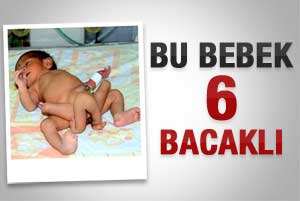 Pakistan'da 6 bacaklı bebek dünyaya geldi