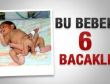 Pakistan'da 6 bacaklı bebek dünyaya geldi